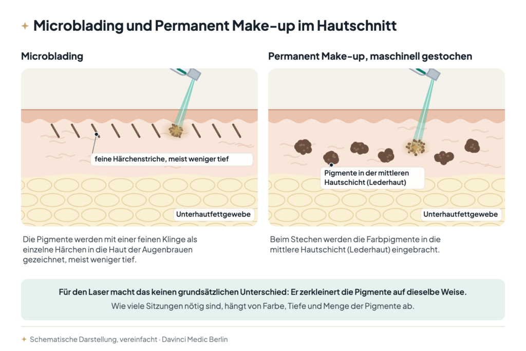 Microblading und Permanent Make-up entfernen: Hautschnitt mit feinen Härchenstrichen beim Microblading und Pigmenten in der Lederhaut beim maschinellen Permanent Make-up, die der Laser jeweils zerkleinert