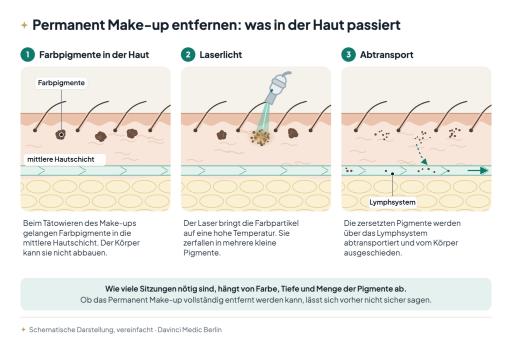 Permanent Make-up entfernen im Hautschnitt der Augenbraue: Farbpigmente in der mittleren Hautschicht, Zerfall durch Laserlicht, Abtransport über die Lymphe