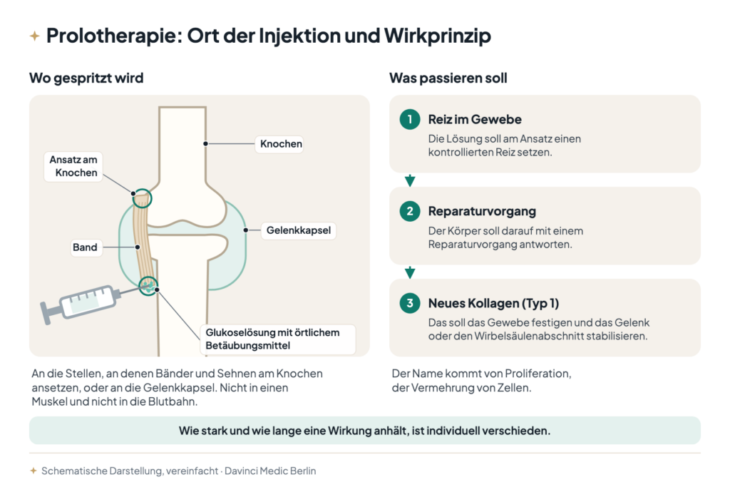 Prolotherapie in Berlin: Schema eines Knies mit Band, Ansatz am Knochen und Gelenkkapsel, Injektion von Glukoselösung mit örtlichem Betäubungsmittel an den Bandansatz; daneben Reiz im Gewebe, Reparaturvorgang und neues Kollagen