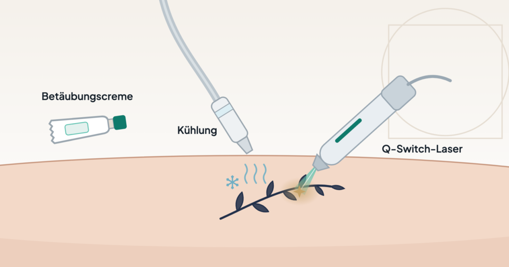 Tattoos und Permanent Make-up per Laser entfernen: Zeichnung mit Laser-Handstück, Kühldüse und Tube mit Betäubungscreme an einem Unterarm