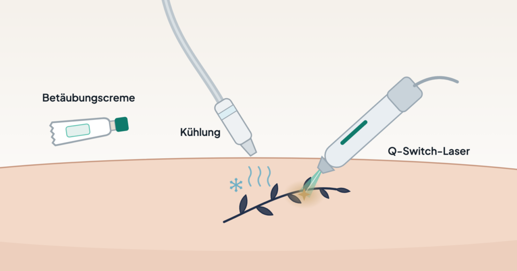 Tattoos und Permanent Make-up per Laser entfernen: Zeichnung mit Laser-Handstück, Kühldüse und Tube mit Betäubungscreme an einem Unterarm