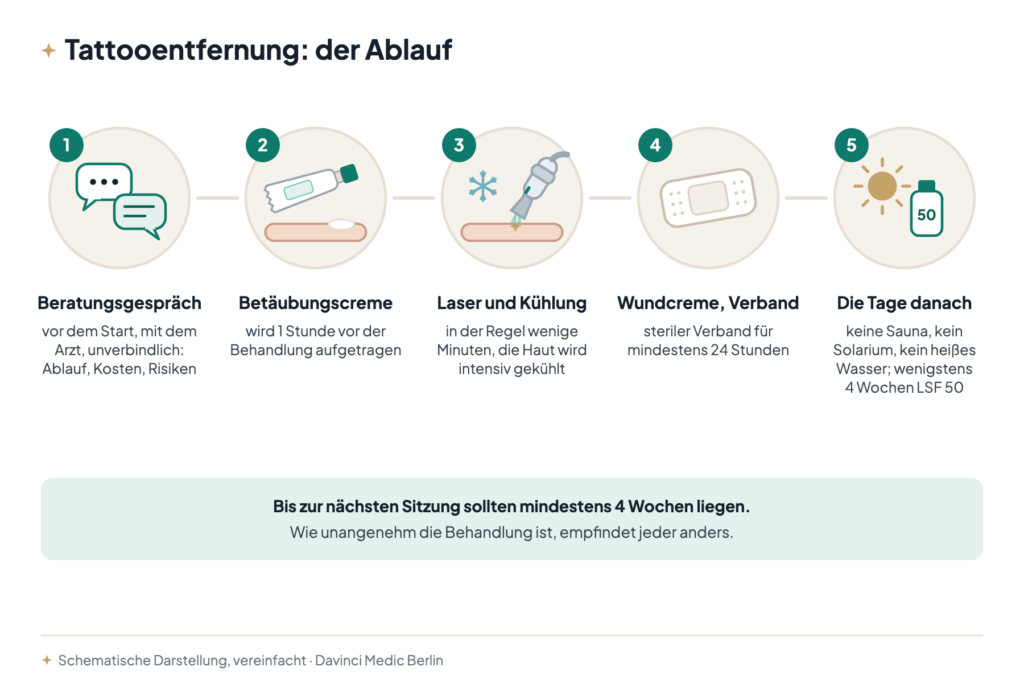 Ablauf der Tattooentfernung in fünf Schritten: Beratungsgespräch, Betäubungscreme, Laser mit Kühlung, steriler Verband, Pflege mit LSF 50