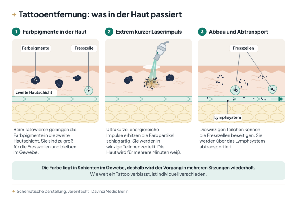Tattooentfernung mit dem Laser im Hautschnitt: Farbpigmente in der zweiten Hautschicht, Zerfall im Laserimpuls, Abtransport über Fresszellen und Lymphsystem