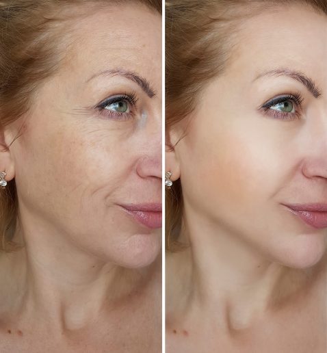 Face,Woman,Wrinkles,Before,And,After,Treatments