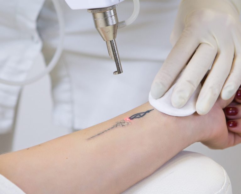 Close-up,Of,Laser,Tattoo,Removal,From,Woman,Hand.