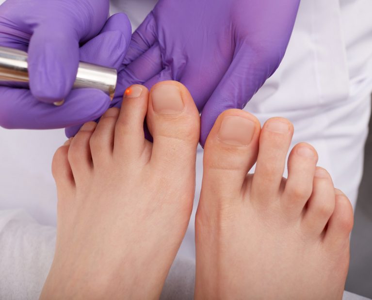 Laser,Treatment,Of,Onychomycosis,For,Woman's,Foot,Toenail,,Close-up.,Laser